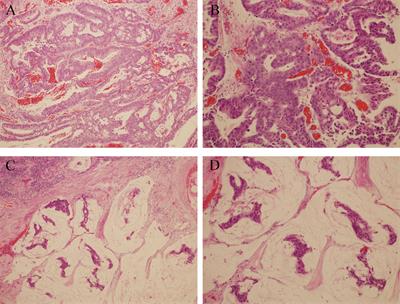 Metastatic Urachal Carcinoma Treated With Several Different Combined Regimens: A Case Report